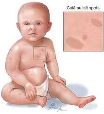 U sợi thần kinh loại 1 (NF1) - Hình ảnh minh họa